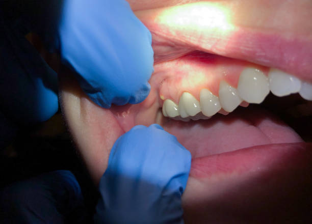 Best Emergency Treatment for Dental Infections or Abscesses in Cleveland, MS